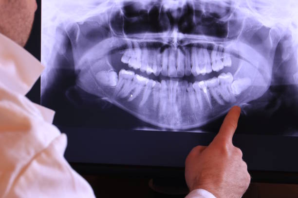 Best Emergency Wisdom Teeth Removal in Rothschild, WI