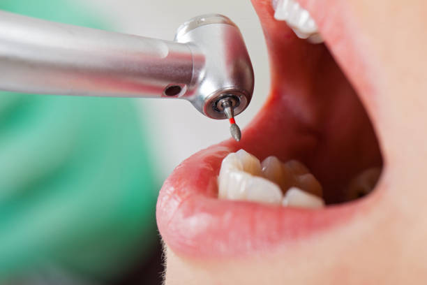 Best Emergency Tooth Extraction in Rothschild, WI